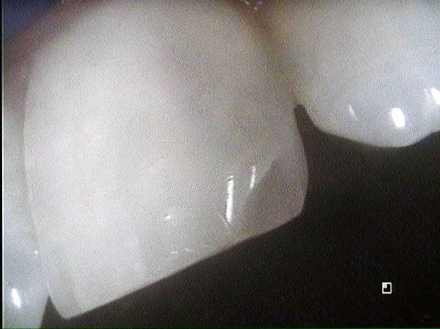 Image of Shawn's Tooth Before Composite Bonding