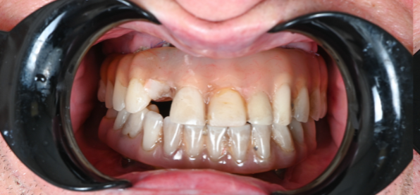 Close-up of a mouth with a broken set of dentures, held open by a dental retractor.