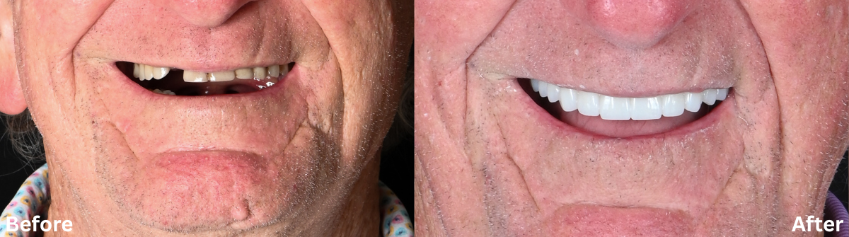 Before and after of a man's smile with a missing tooth, and after dental work to replace it.
