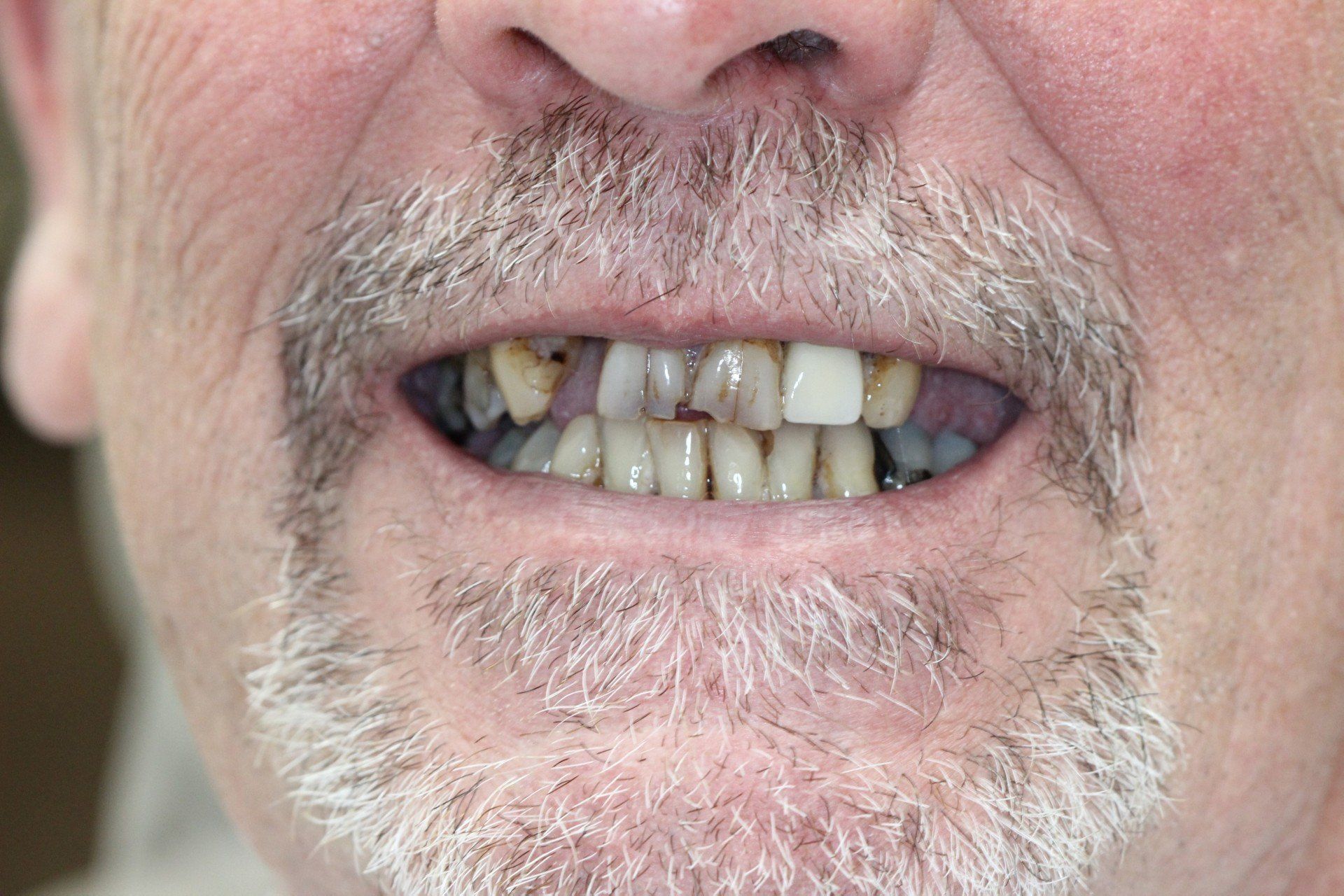 A close up of a man 's mouth with a beard and missing teeth.
