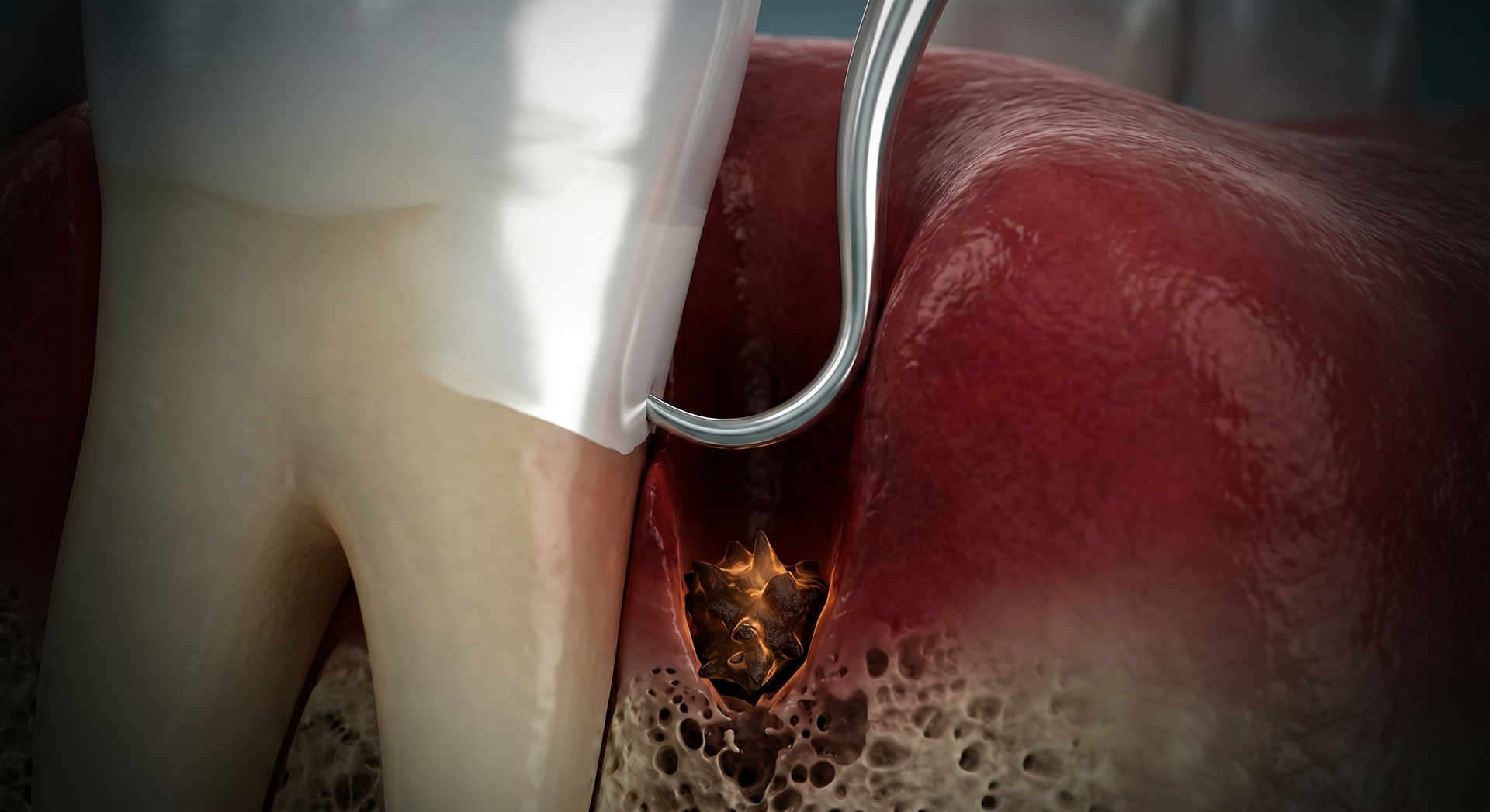 Dental tool removing a dark filling from a red, decayed tooth