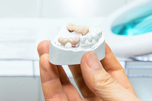 Dental Bridges - StarBrite Dental Services