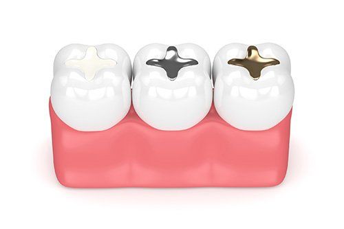 Dental Fillings - StarBrite Dental Services