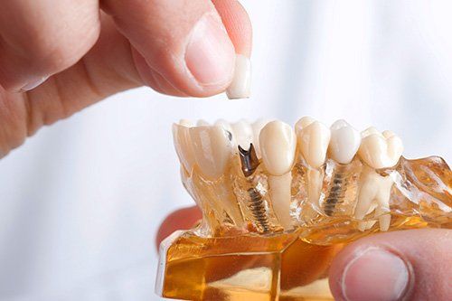Dental Implants - StarBrite Dental Services