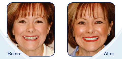 Female Dental Veneers Patient Before and After Photos