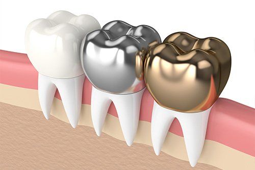 Dental Crowns - StarBrite Dental Services