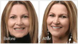 Female Dental Veneers Patent Before and After Photos