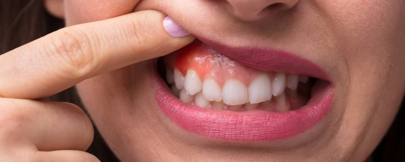 Swollen Gum Behind Molar - Causes, Treatment and Prevention