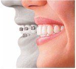 picture of one person with clear aligners and anothe person with braces