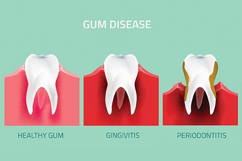 Illustration of gum disease from healthy to gingivitis and finally periodontitis