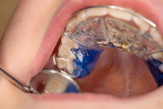 What is a Palatal Expander?