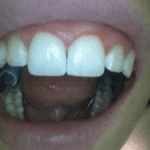 Photo of Teeth After Composite Was Placed