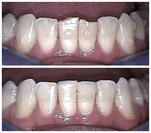 Before and After Photos of Teeth with Dental Bonding