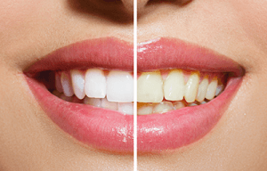 White vs Yellow Teeth