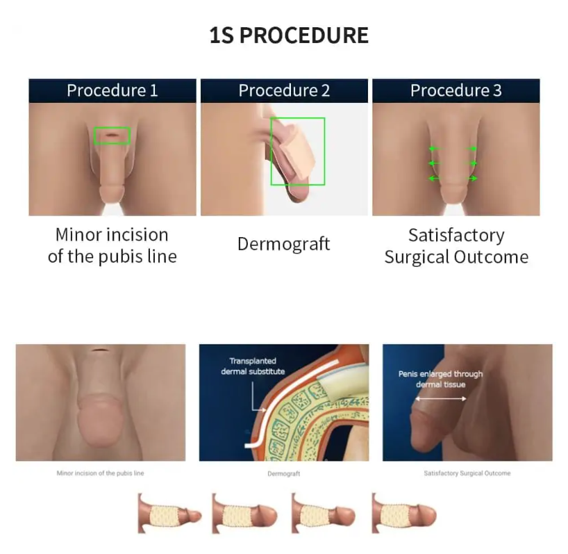 Penile Enlargement Surgery | Proud Urology Clinic Gangnam