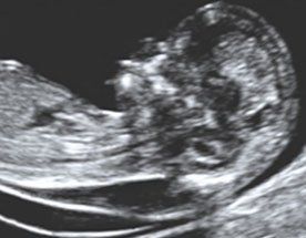 translucenza anormale