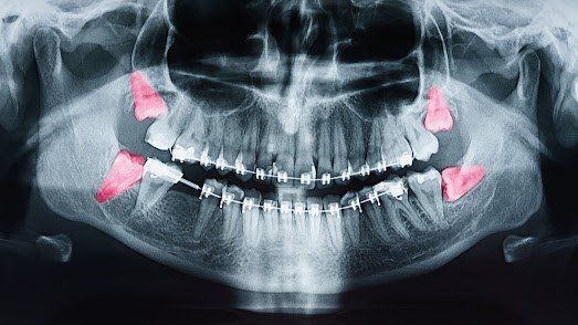 Tooth X-Ray — Lancaster, PA — Conestoga Oral Surgery