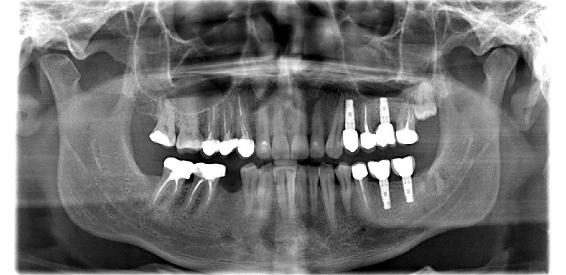 X-ray after dental implants in Lancaster, PA