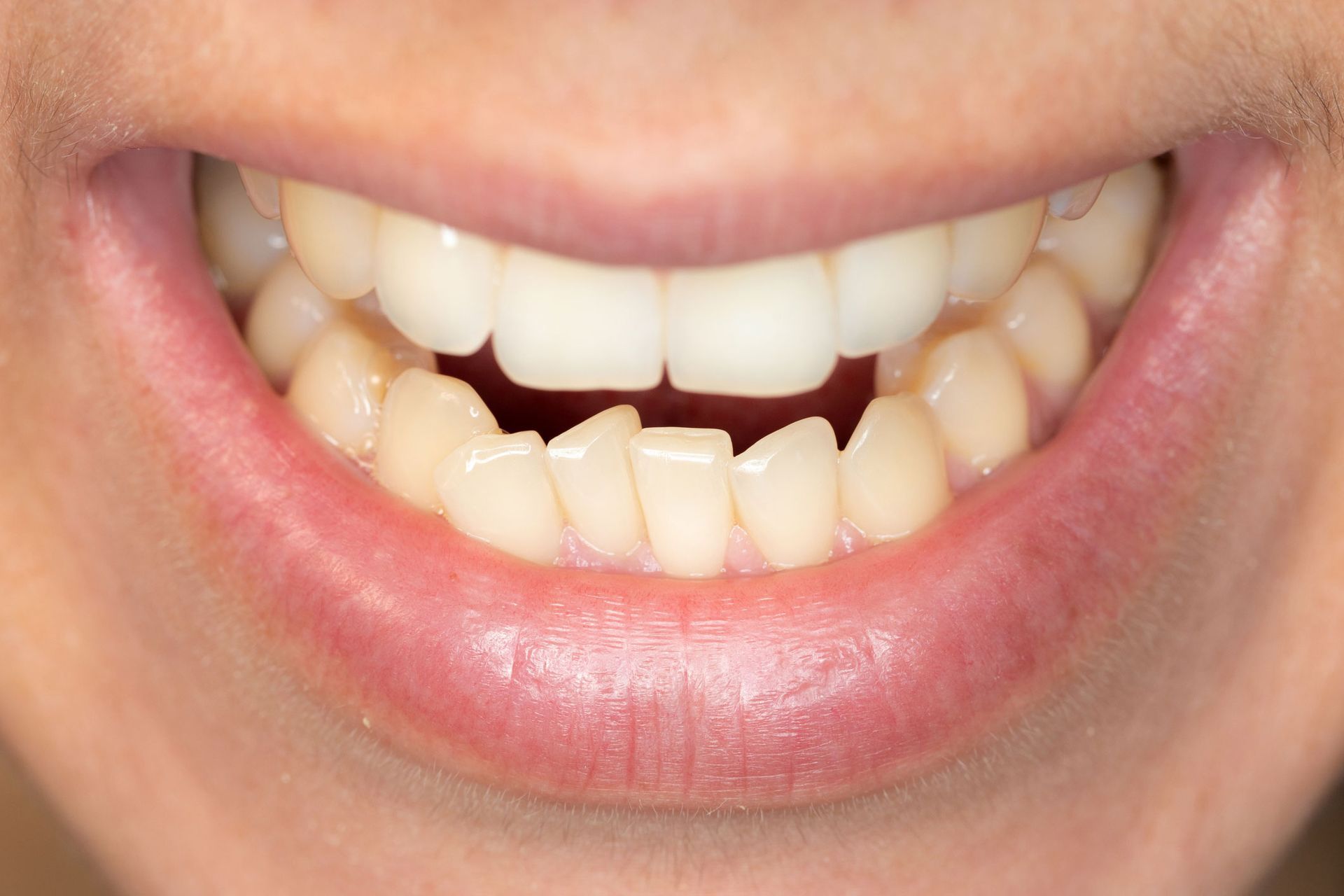 Crowding Of The Teeth — Lancaster, PA — Conestoga Oral Surgery