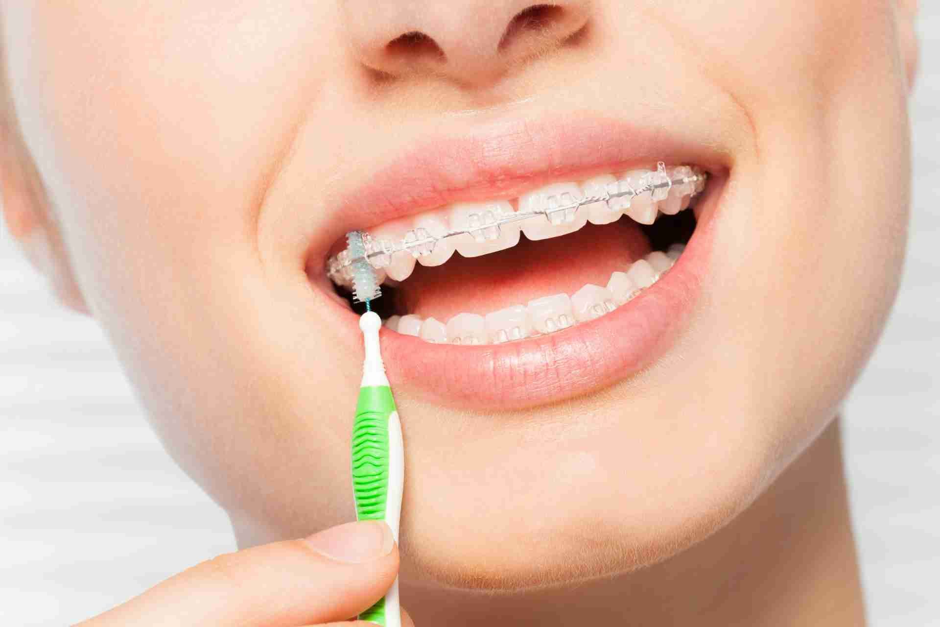 how to care for braces