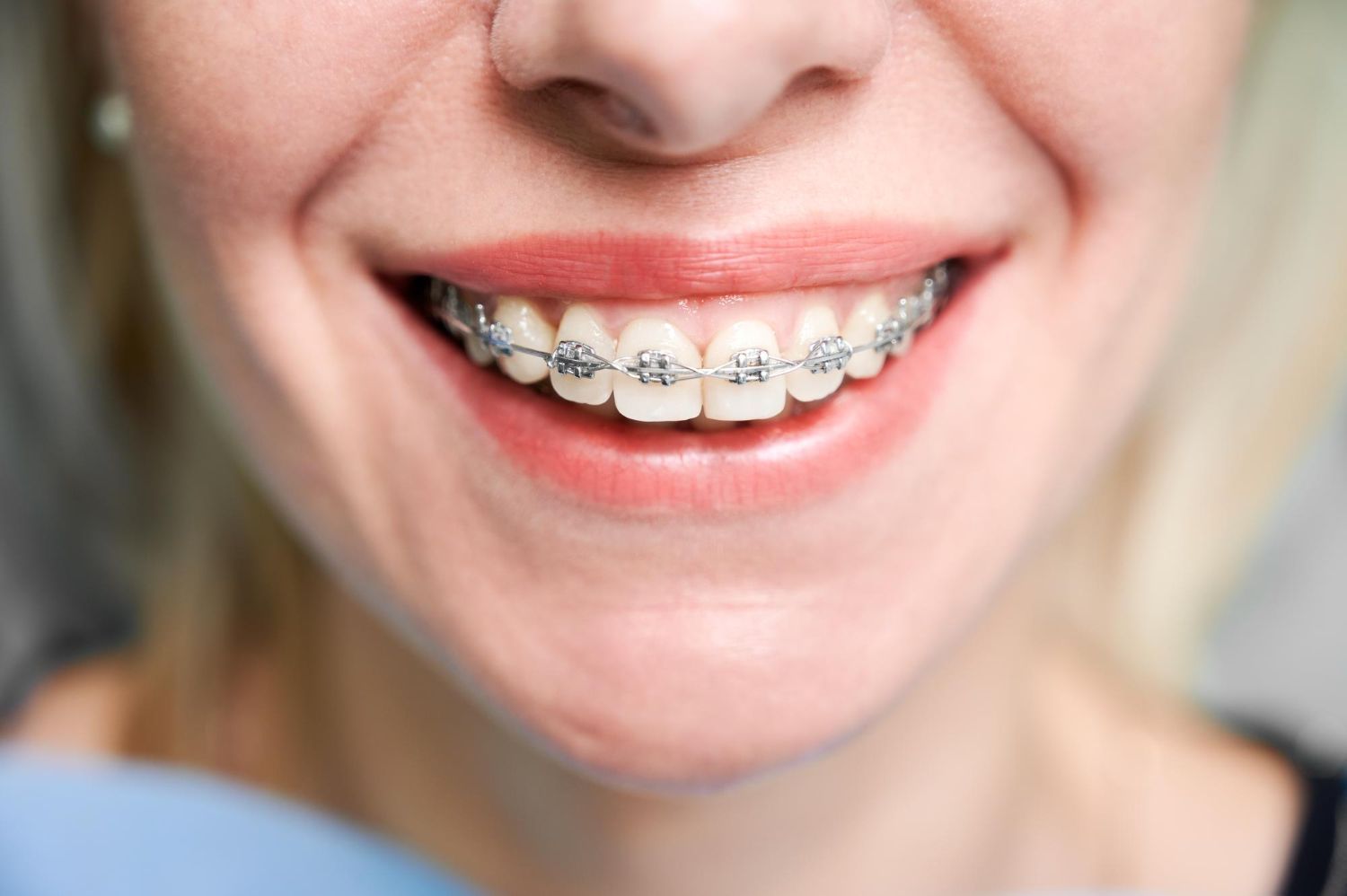 Retainers vs Braces: Which is Best?