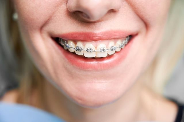 Teeth Retainer 