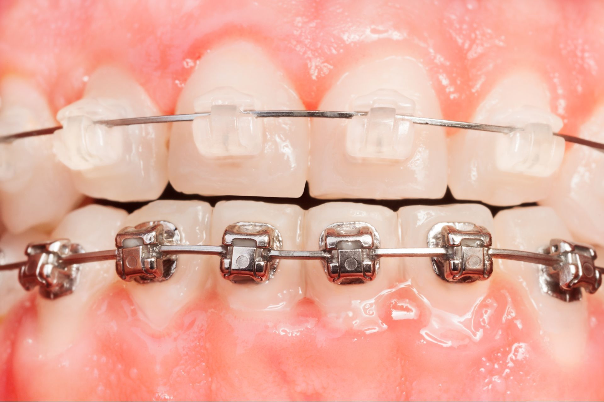 ceramic vs metal braces pros and cons