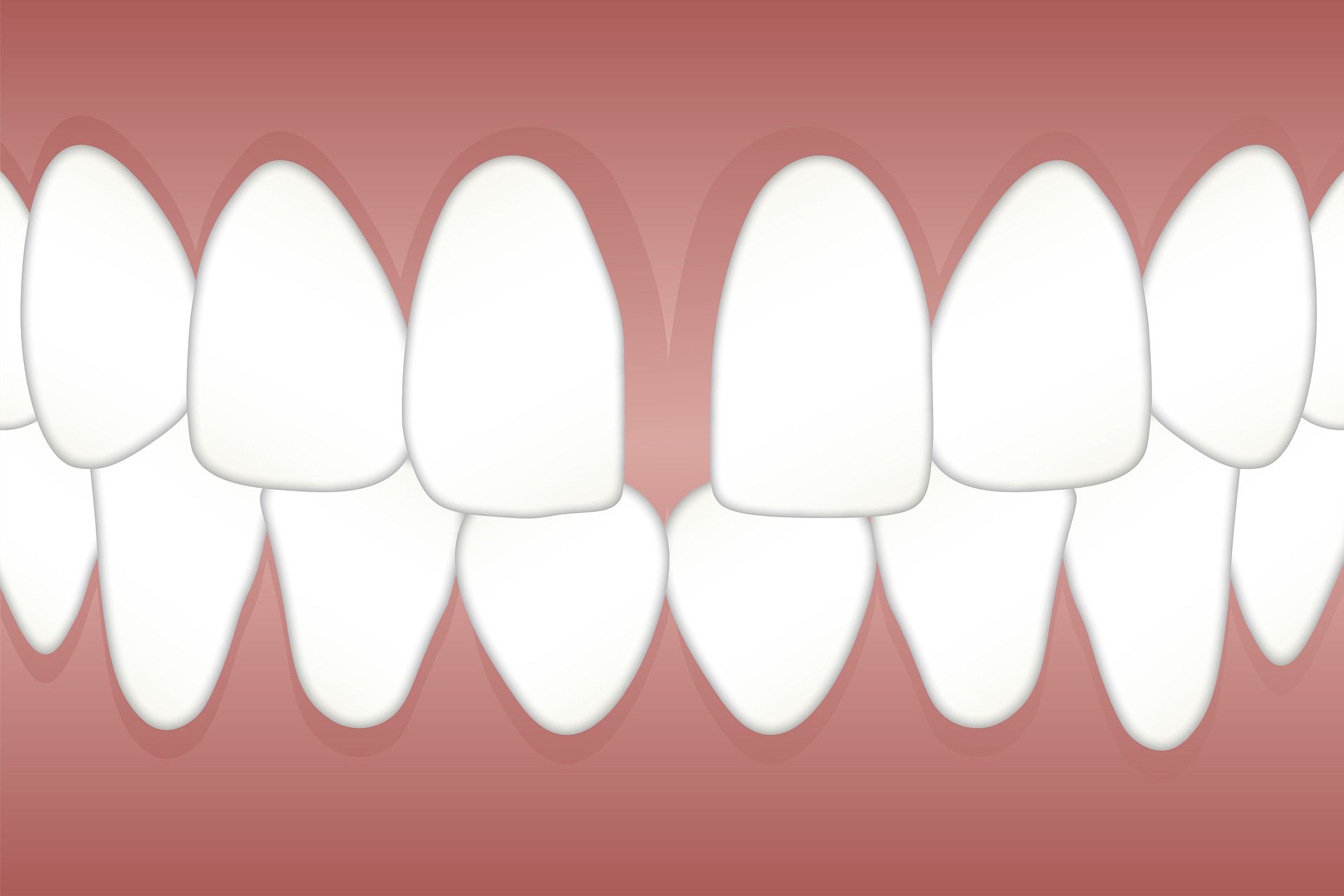 filling tooth gaps