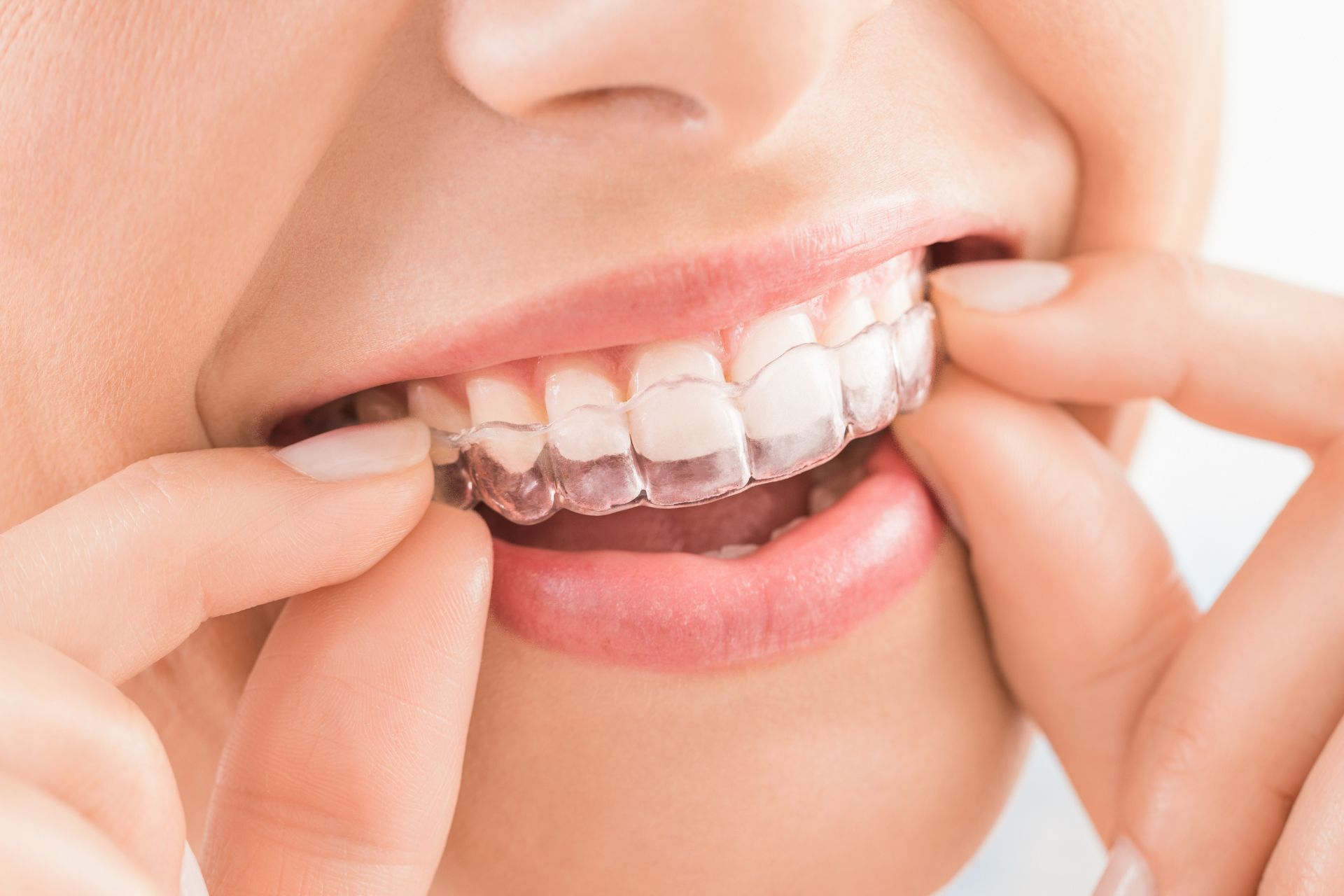 how does invisalign work