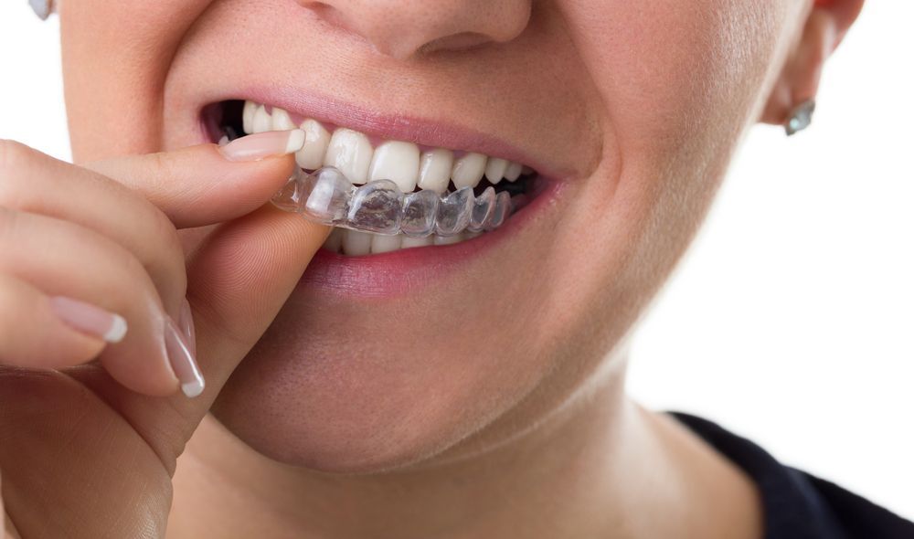 why you should wear retainers