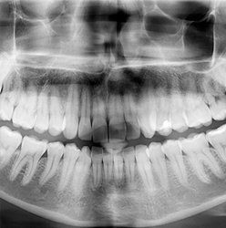 Teeth xray — Dental Implants in Springfield, PA