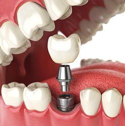 Dental implants — Dentists in Springfield, PA
