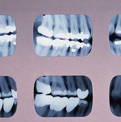 Teeth xrays — periodontal treatment in Springfield, PA