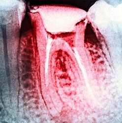 Decayed teeth — tooth care in Springfield, PA