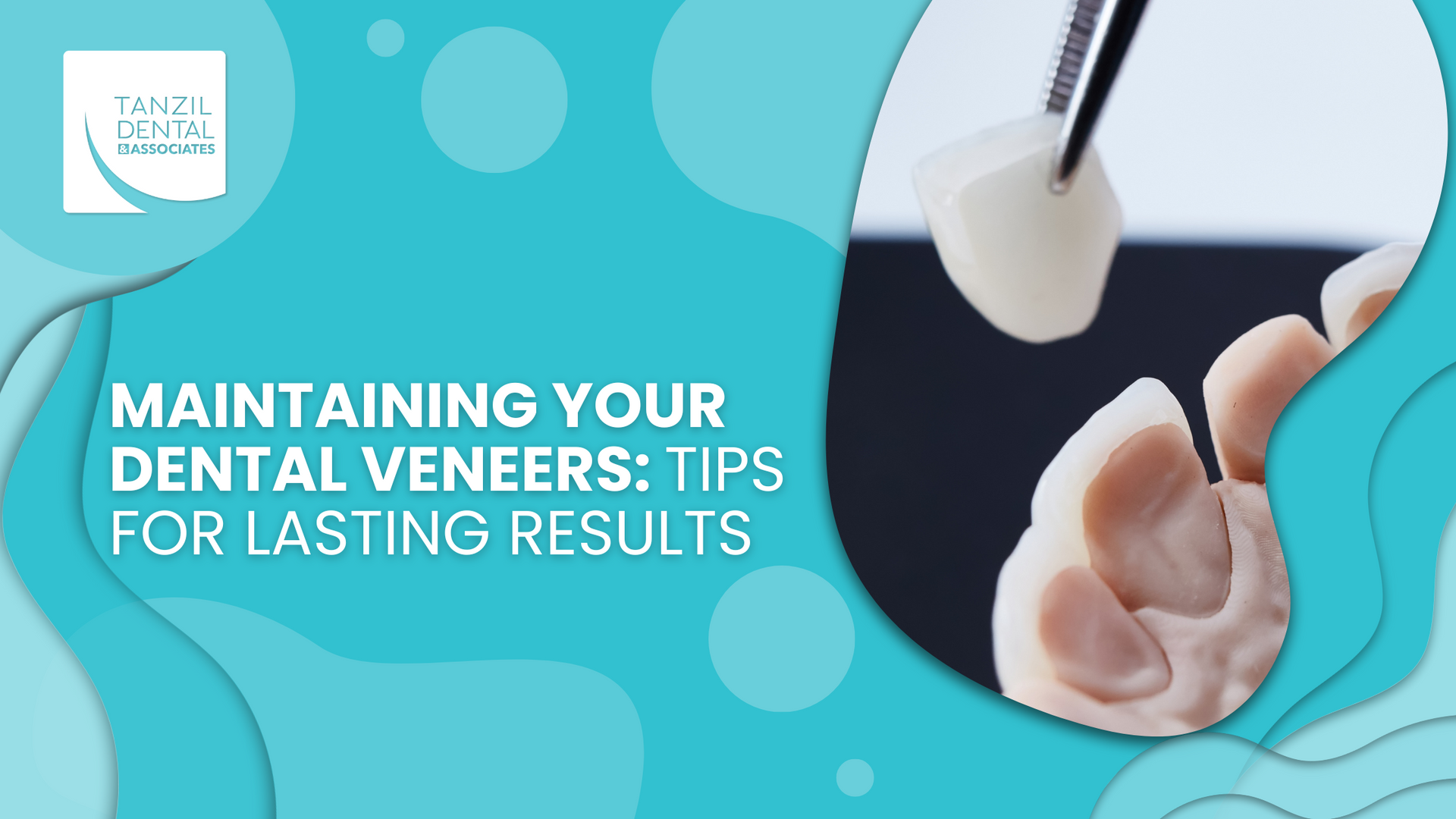 Maintaining your dental veneers : tips for lasting results