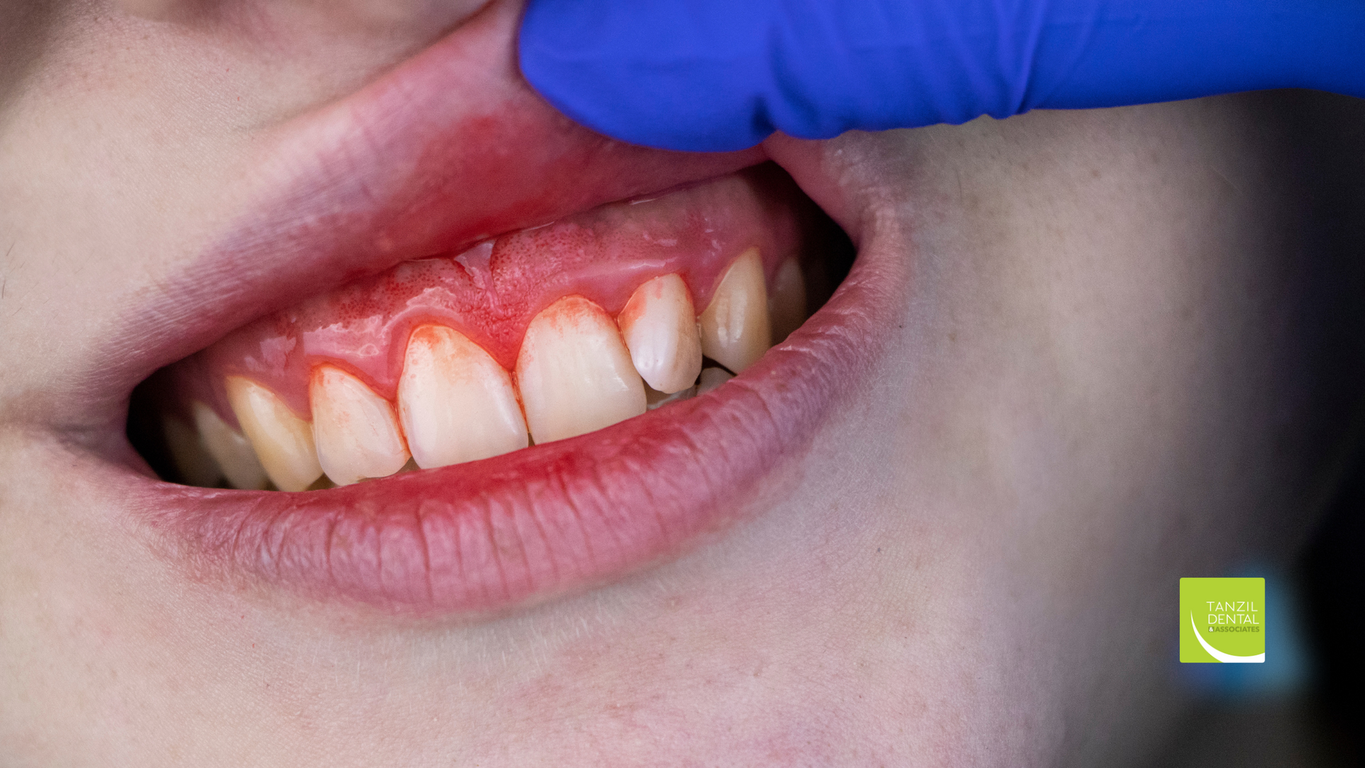 A close up of a person 's teeth with a blue glove on.