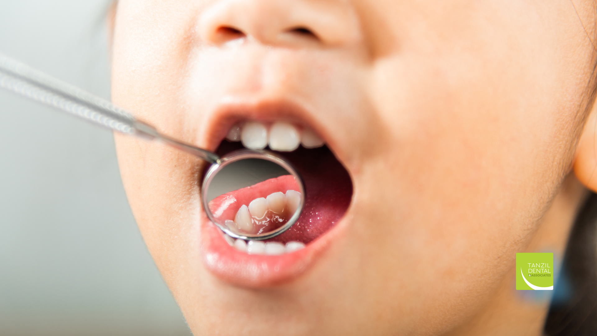 Mouth open, dental mirror reflecting teeth, pink gums visible.