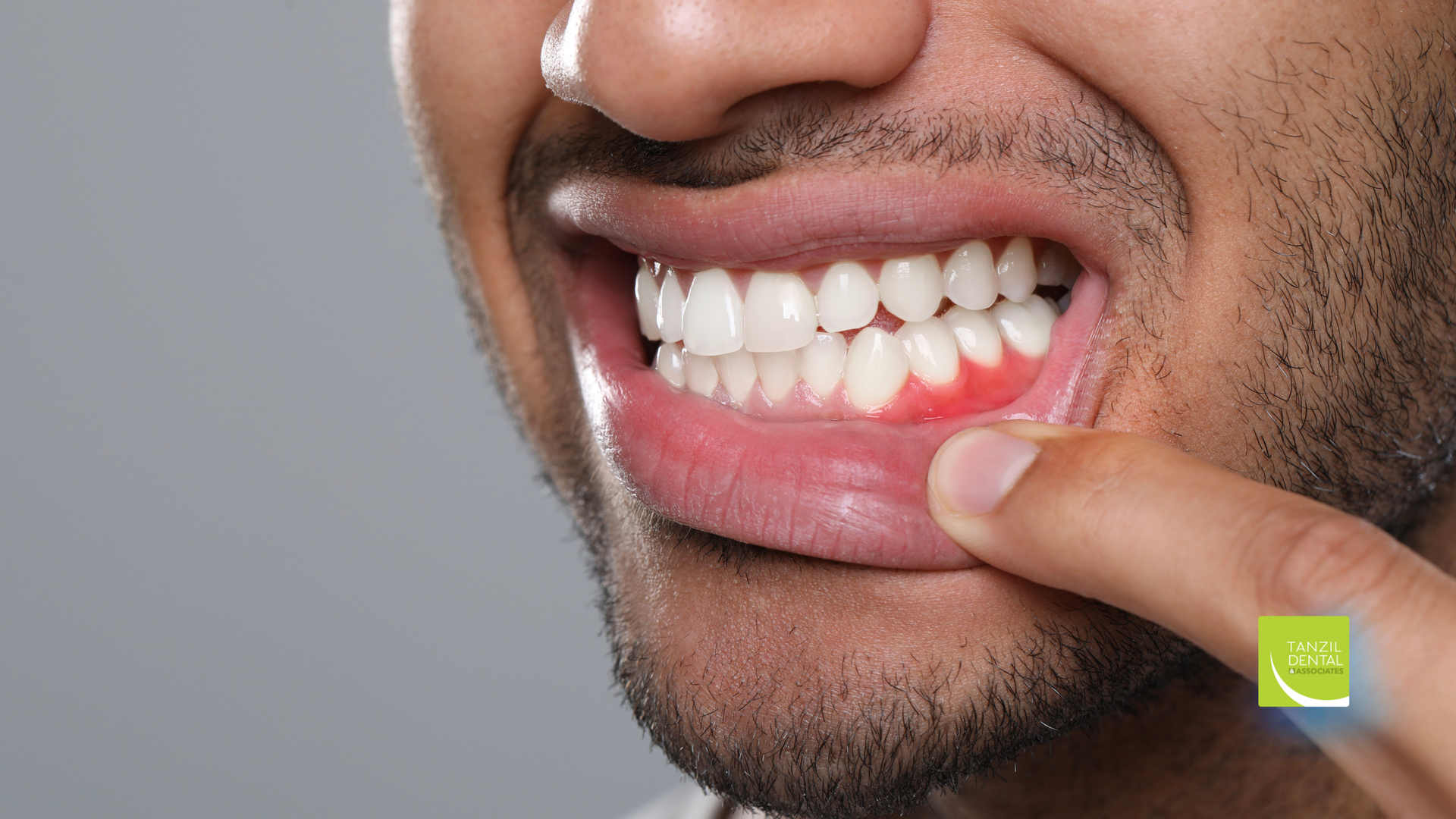 Man pointing to inflamed, red gums in his mouth.