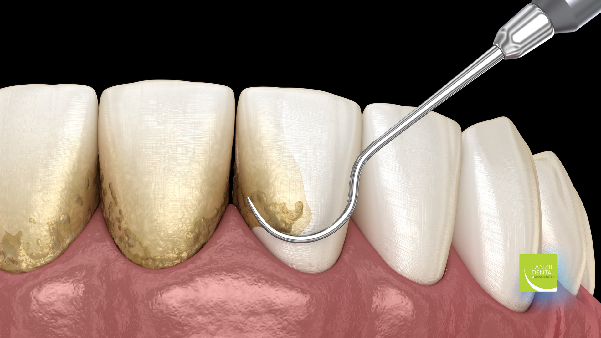 A close up of a tooth with a hook in it.