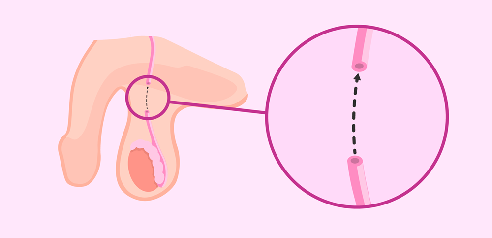 Como reverter a vasectomia: tudo o que você precisa saber Como reverter a vasectomia: tudo o que você precisa saber