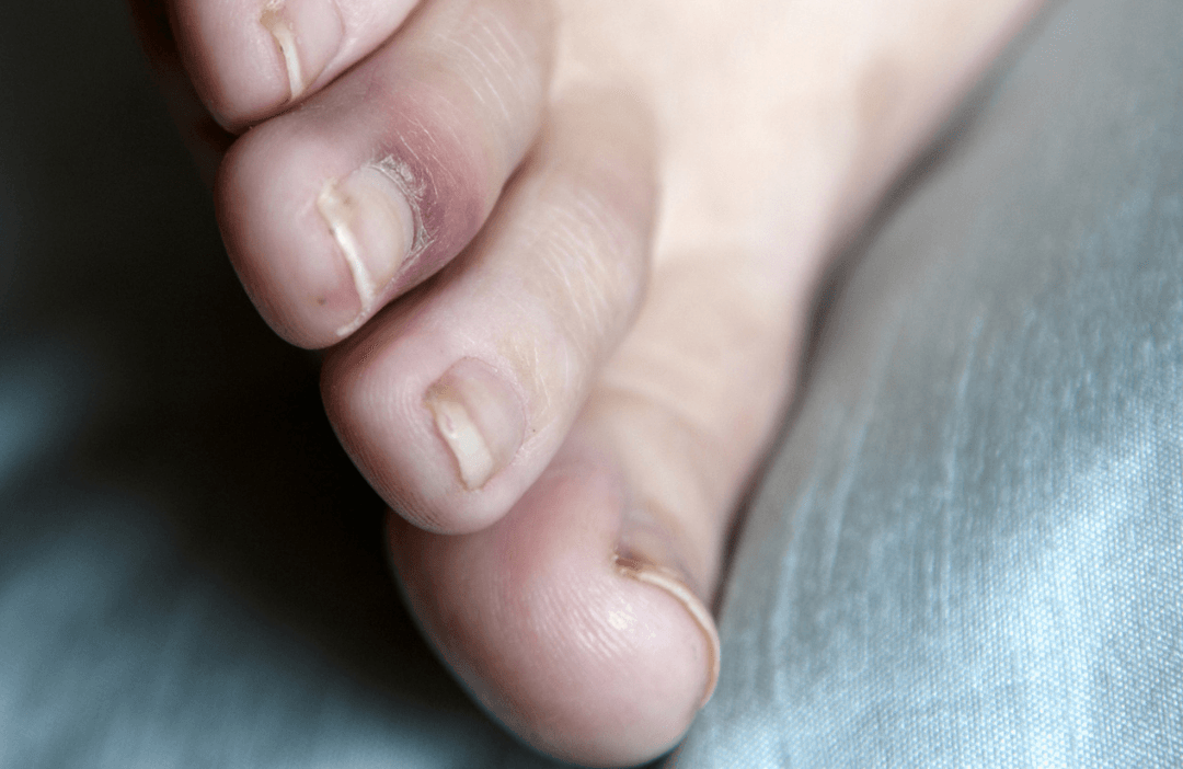 chilblain on toes