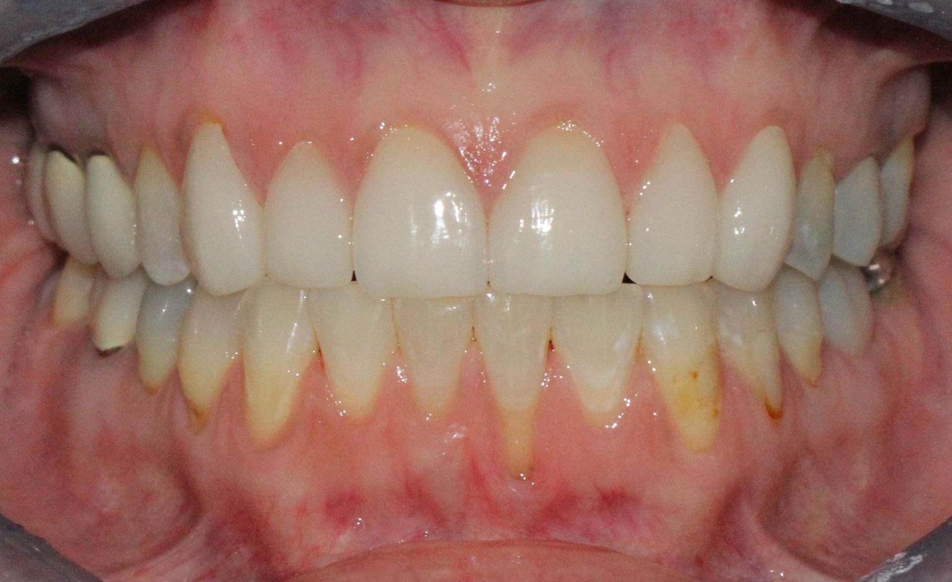 A close up of a person 's teeth with white teeth.