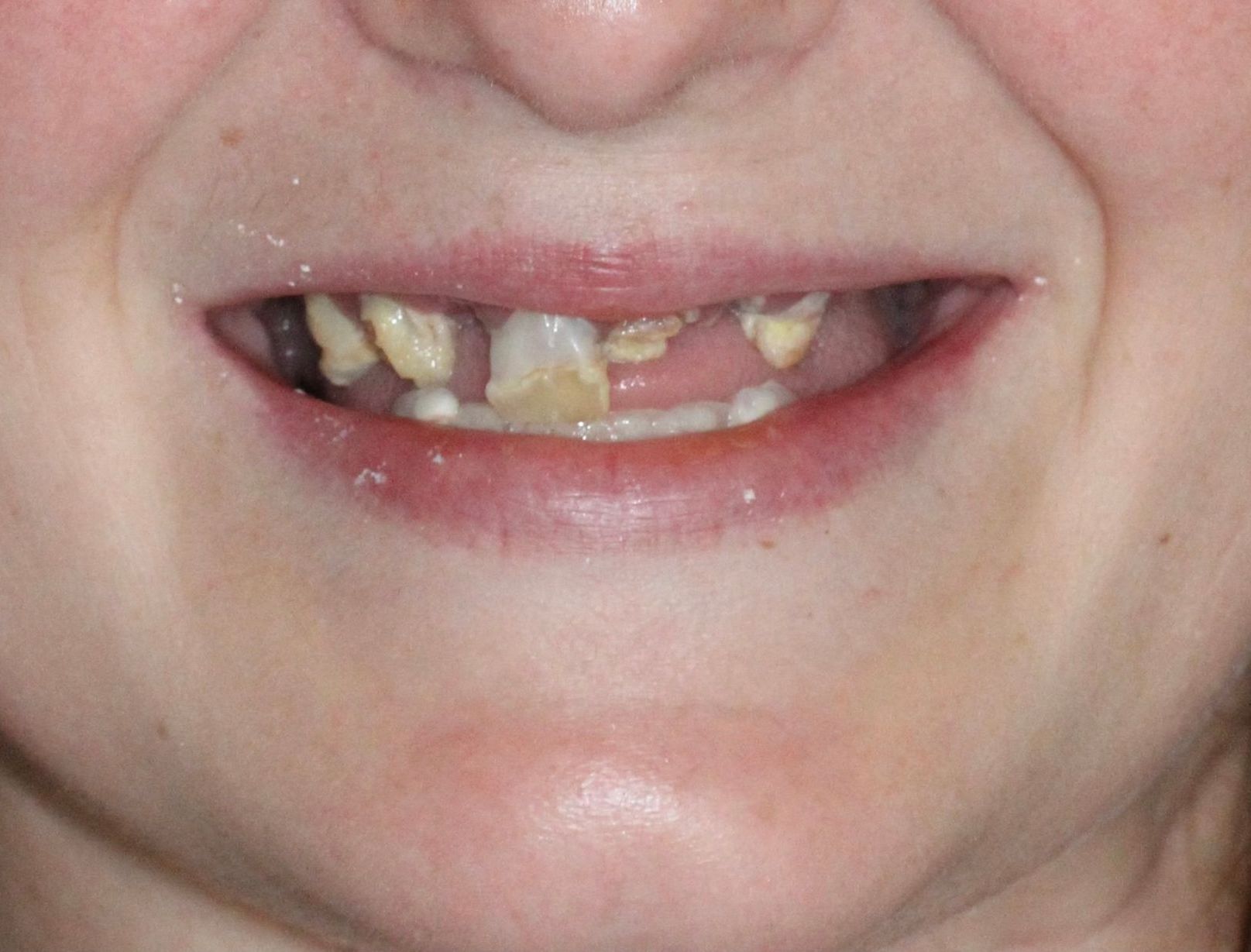 A close up of a woman 's mouth with missing teeth.