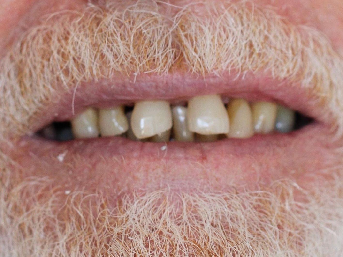 A close up of a man 's mouth with a beard and missing teeth.