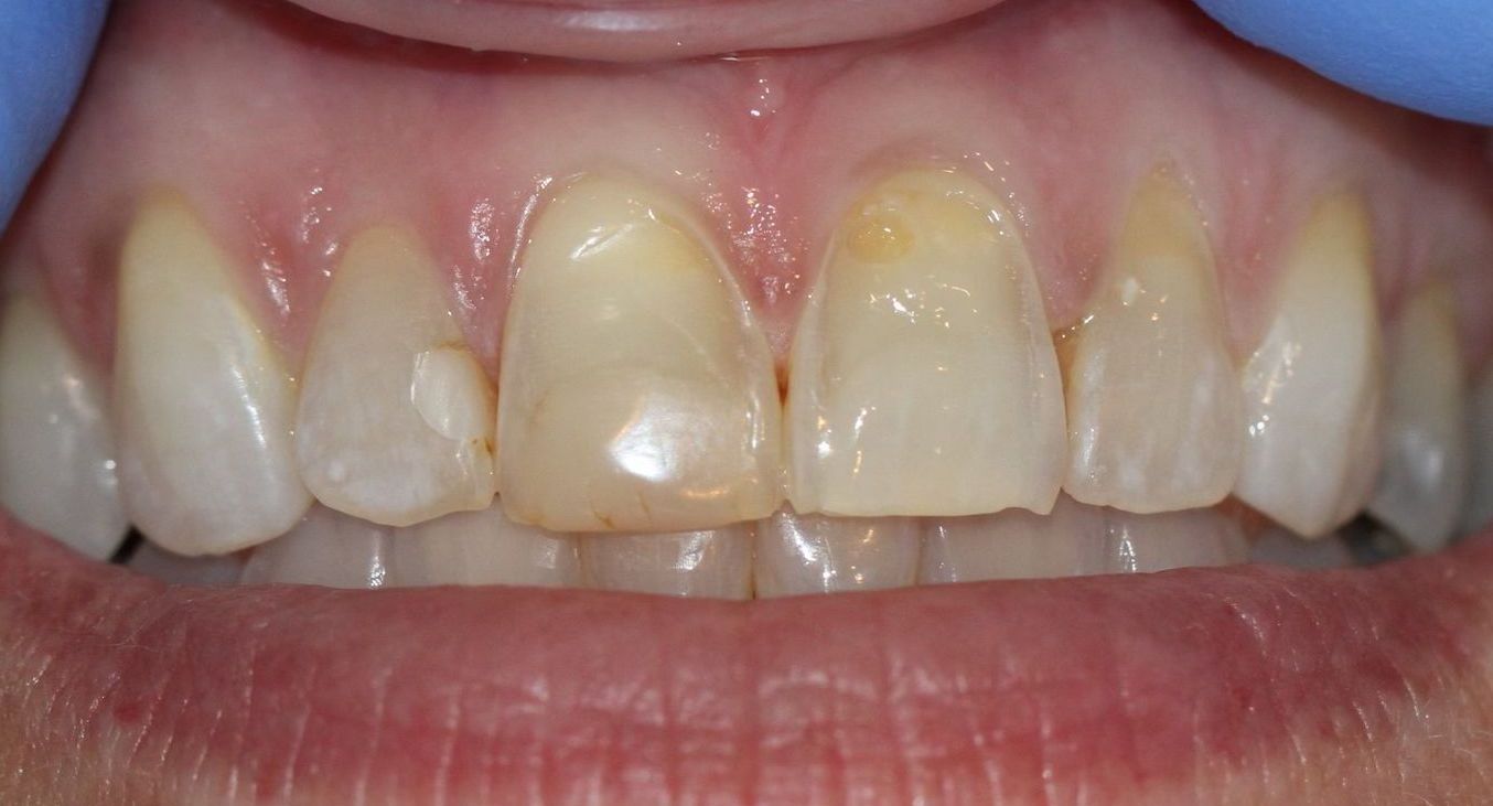 A close up of a person 's teeth with yellow spots.