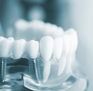 a close up of a model of teeth with dental implants .
