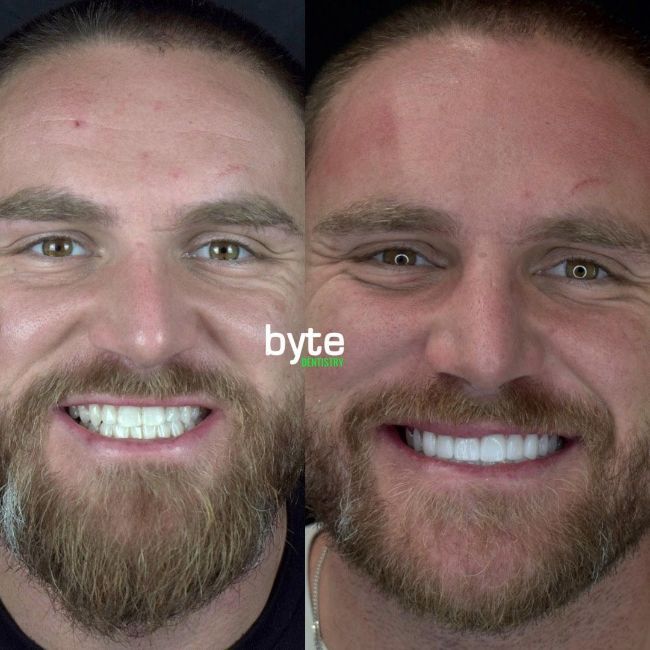 Patient Before & After Teeth Whitening
