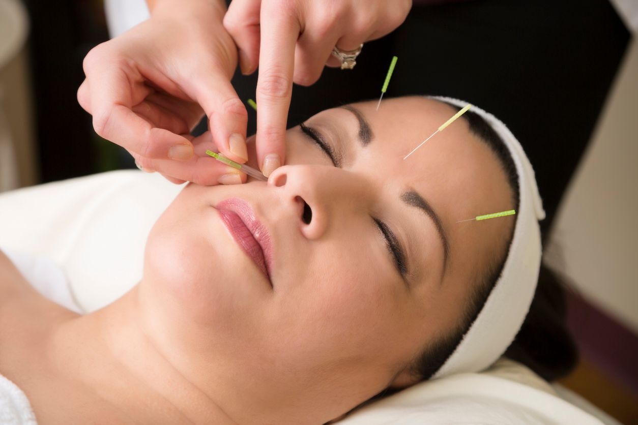 A woman is getting an acupuncture treatment on her face.