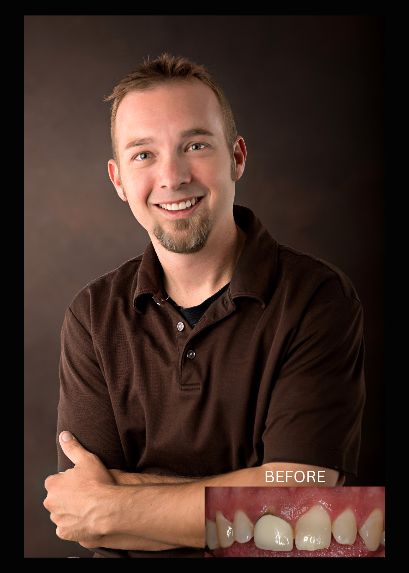 SmileArt patient smiling, before teeth. Brown polo shirt, dark background. Inset of teeth labeled 