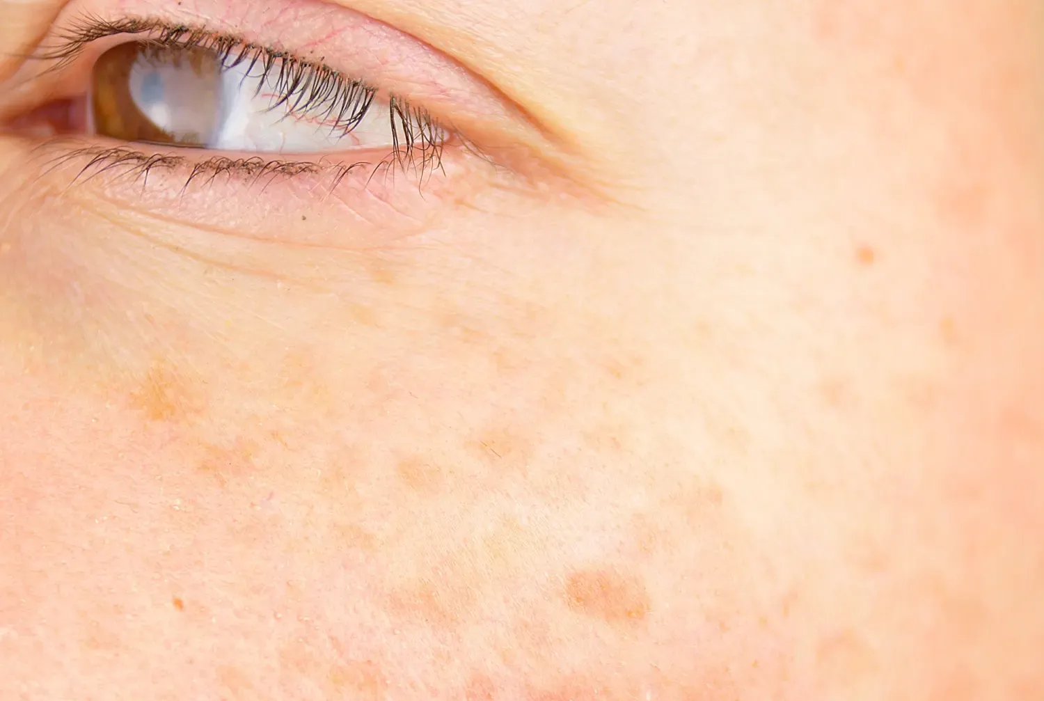 Rosacea treatments in Matawan, NJ